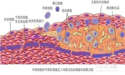 高脂饮食与动脉粥样硬化