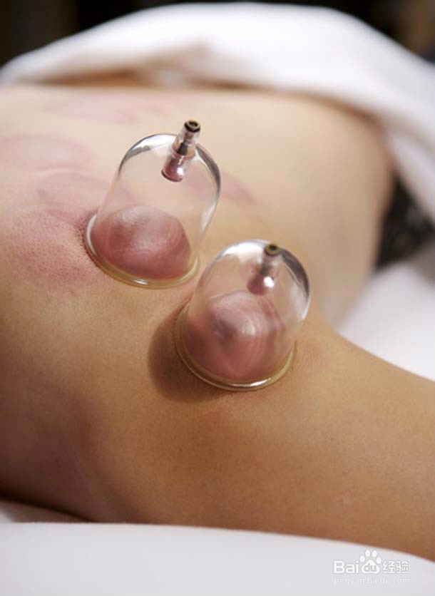 拔火罐,你了解多少?