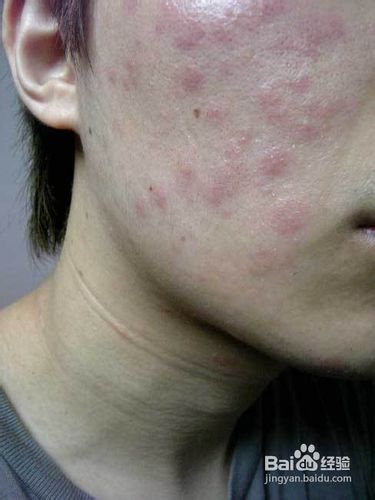 冬季防上火三招