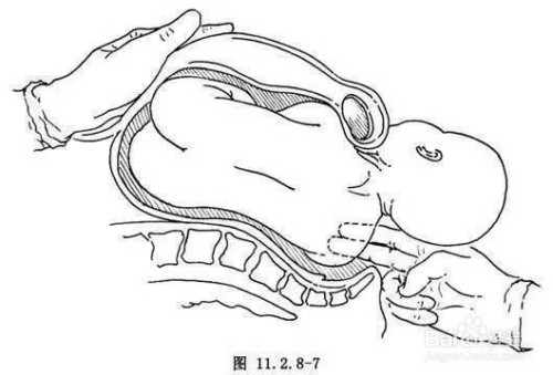 肩难产的七步处理方法
