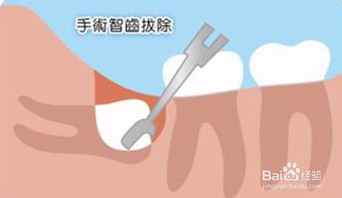 牙疼的时候怎么办？