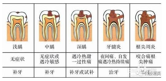 为什么牙齿要做根管治疗根管治疗的步骤