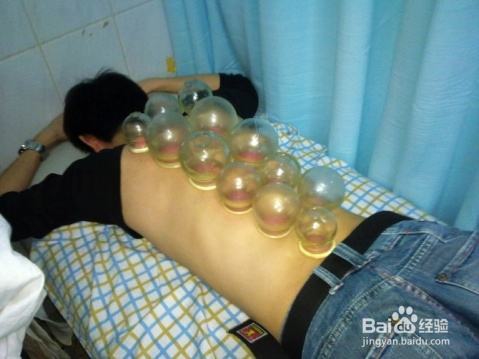 拔火罐的三大禁忌 切记拔完就洗澡