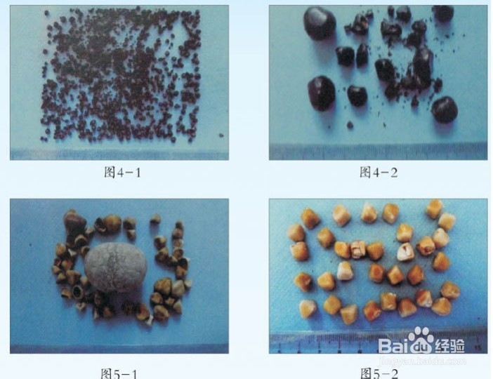 胆结石要做哪些检查
