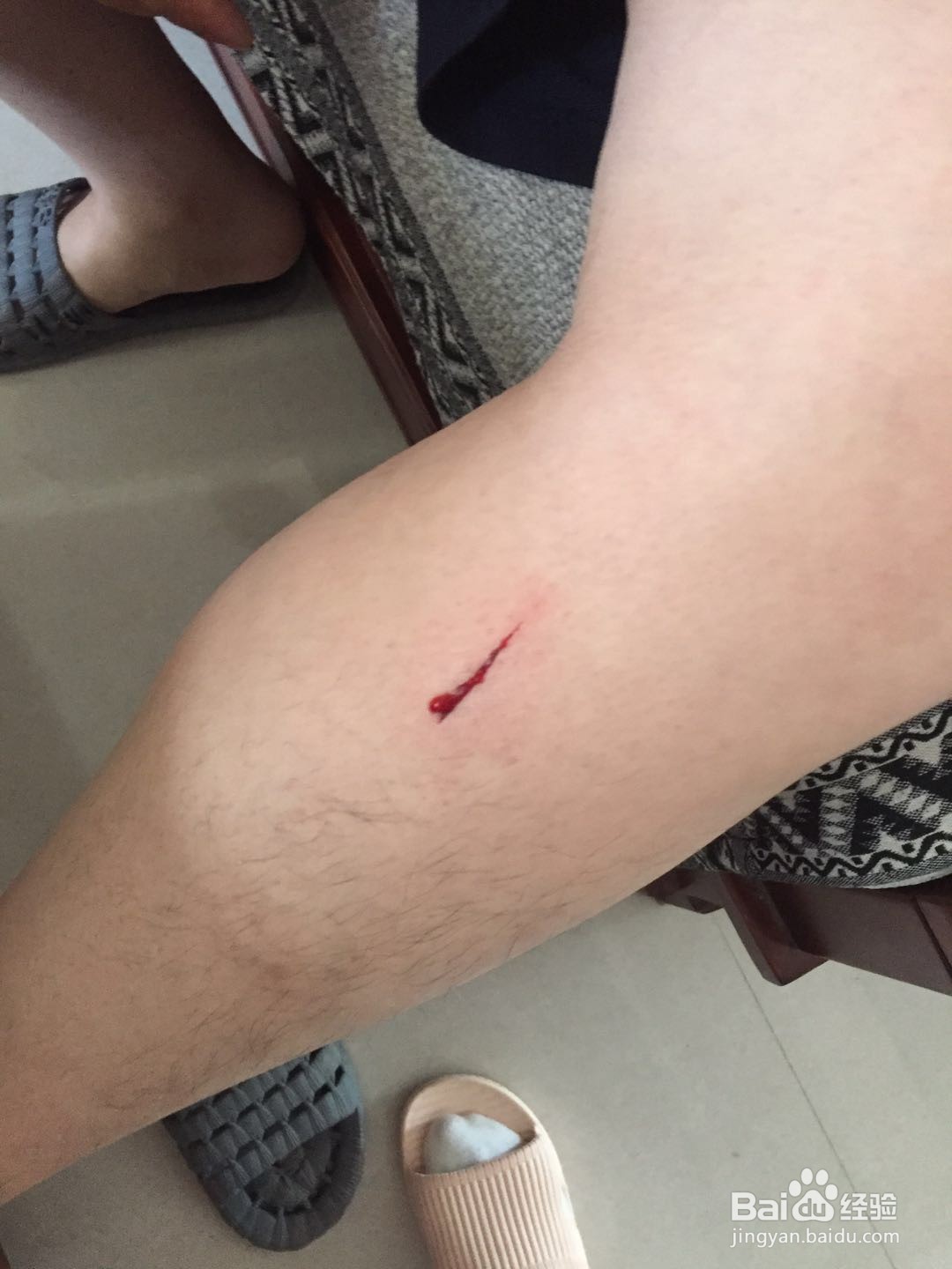 身体出现物品划伤如何处理