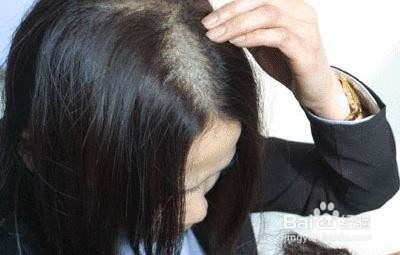 fortro:掉发对生活的影响有那些?