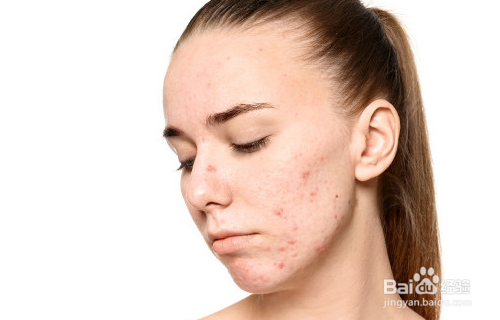 闭口粉刺如何快速消掉