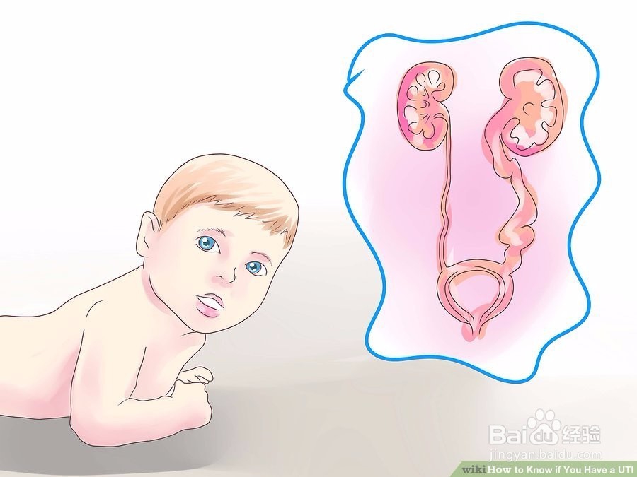 如何知道你是否有UTI
