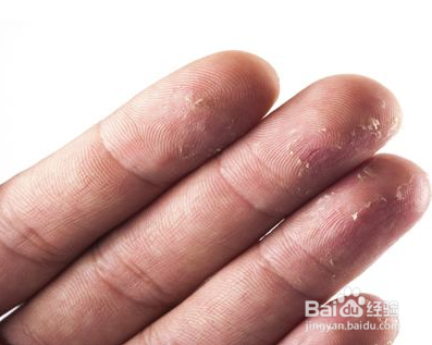 血热的表现及调养