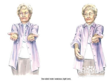 家里老人中风了该怎么办?