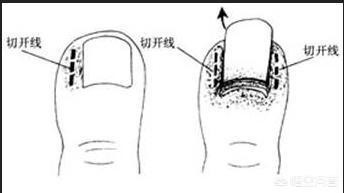 甲沟炎临床表面,得了甲沟炎怎么办