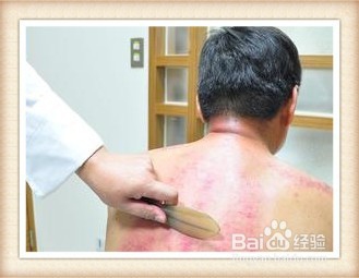 夏天中暑了该怎么办，该如何预防