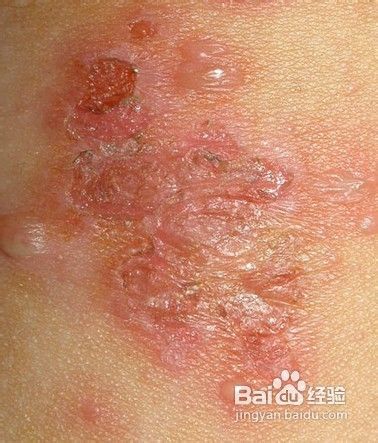 男科之前列腺炎症发病原因集锦