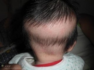 宝宝枕秃怎么办