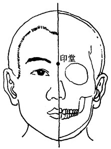 百病刮痧：[52]小儿高热的刮痧疗法