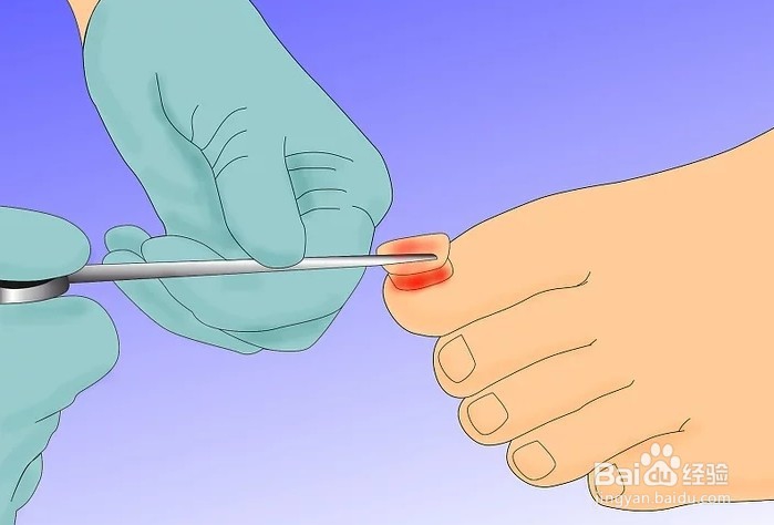 怎么治疗足癣，用什么药比较好