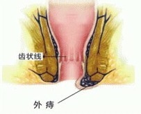 外痔对身体的影响是什么？