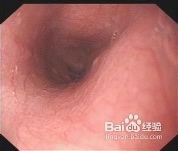 哪些因素会引发萎缩性胃炎