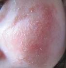 面部湿疹的护理治疗