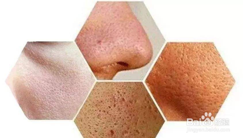 螨虫脸有什么症状？怎样有效去除螨虫？