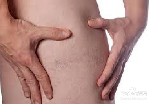 用自然疗法减轻血肿