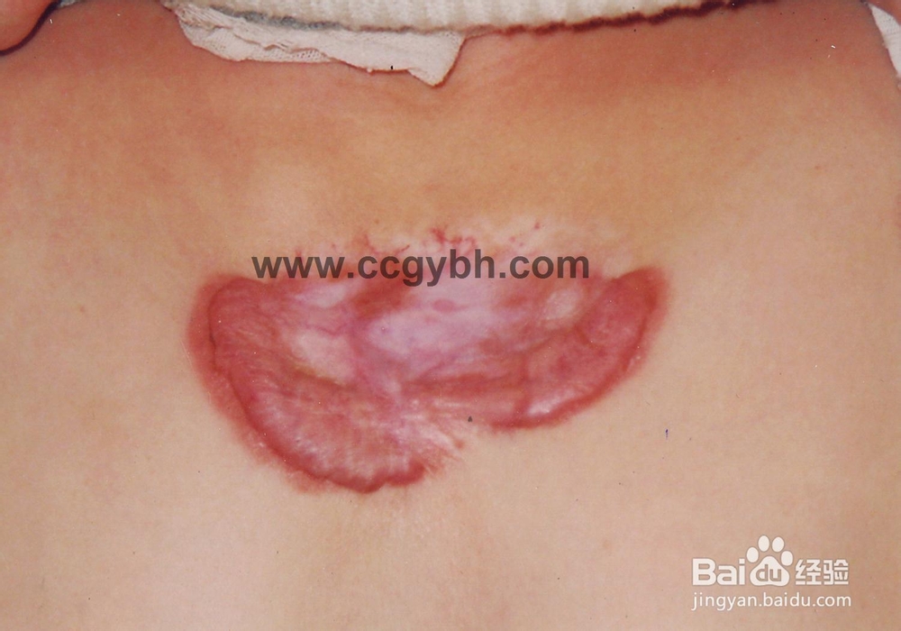 欣疤克祛疤真的有用吗?