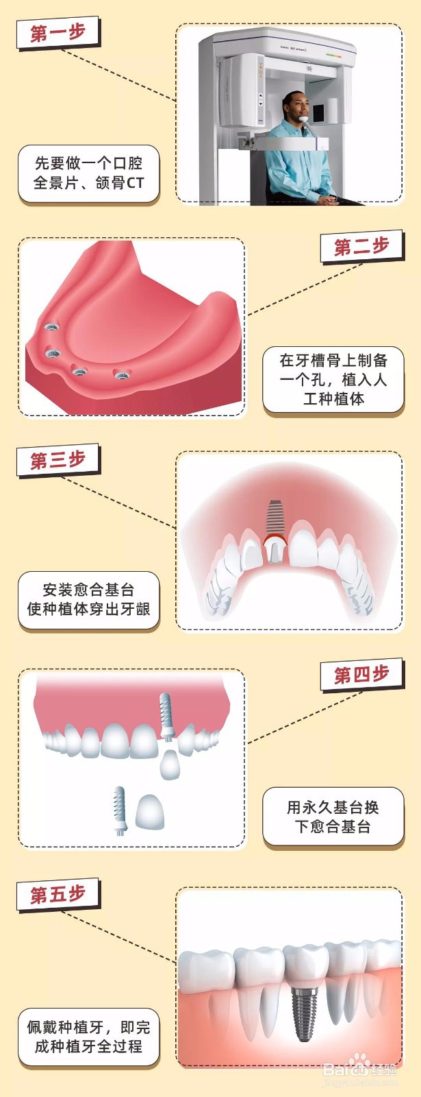 种植牙要打个洞，会不会对牙床造成损伤呢？
