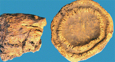 最常用一则肝内胆管结石的偏方