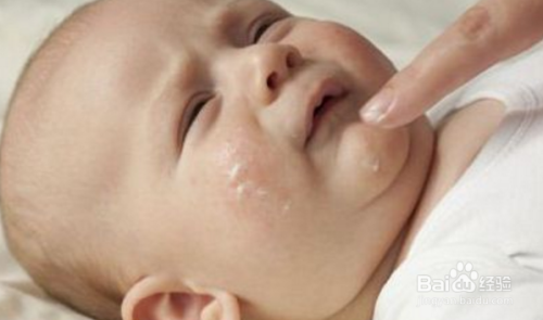 宝宝湿疹了怎么办？