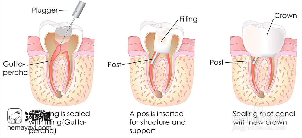 什么是儿童根管治疗以及具体步骤？