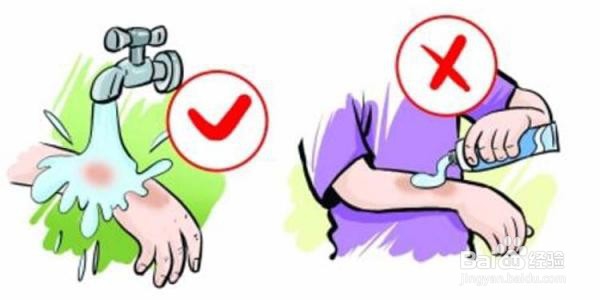 烫伤如何处理及注意事项