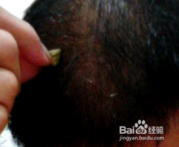 个人脂溢性脱发之生发经验