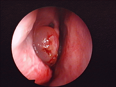 鼻息肉的预防保健有哪些呢