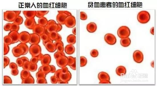 粘膜下子宫肌瘤有哪些症状表现