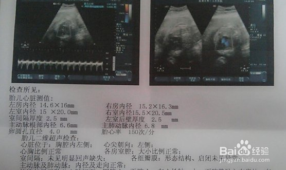 胎心监测怎么一次过
