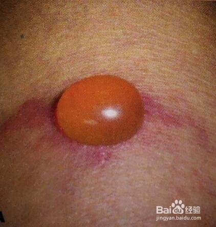 带状疱疹的症状