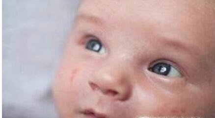 新季节皮肤过敏怎么办