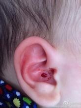 宝宝撞伤后必须立刻就医的情况