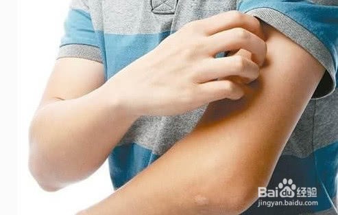 蚊子叮了如何止痒