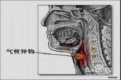 什么是海姆立克急救法