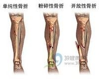 骨折快点康复的几点注意事项