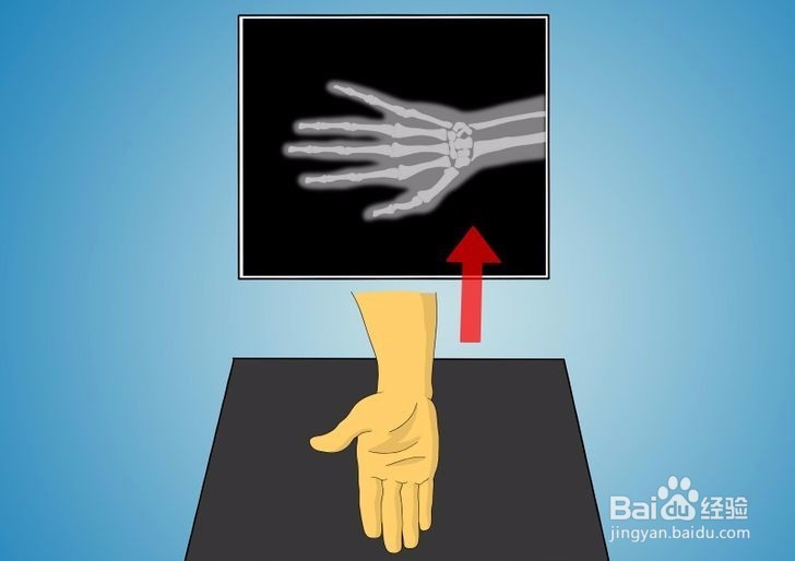 如何诊断拇指是否骨折?