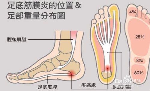 如何避免筋膜炎的发生