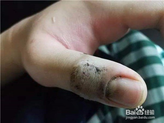 野外毒蛇咬伤的诊断方法及急救措施