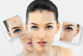 怎样祛痘印需抓住根源