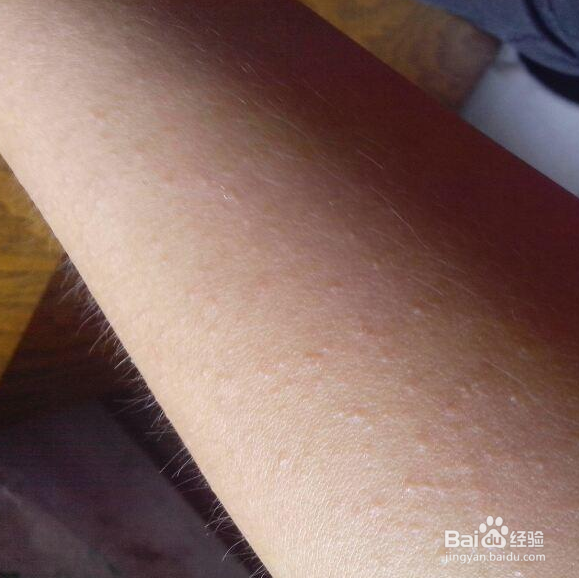 解决皮肤过敏的小秘诀