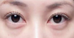 怎样消除眼袋