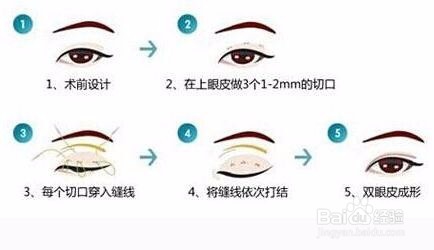 深圳割双眼皮多少钱