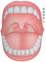 临床上把扁桃体肿大分为三度:  i