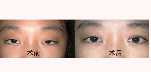 上睑下垂矫正术